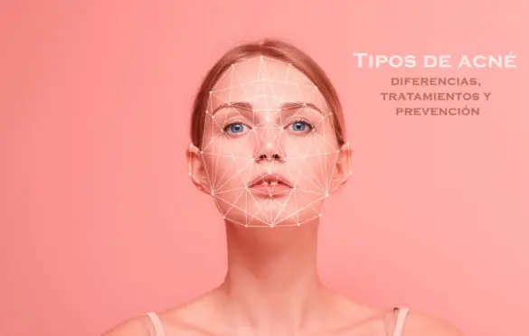 Tipos de acné: diferencias, tratamientos y prevención