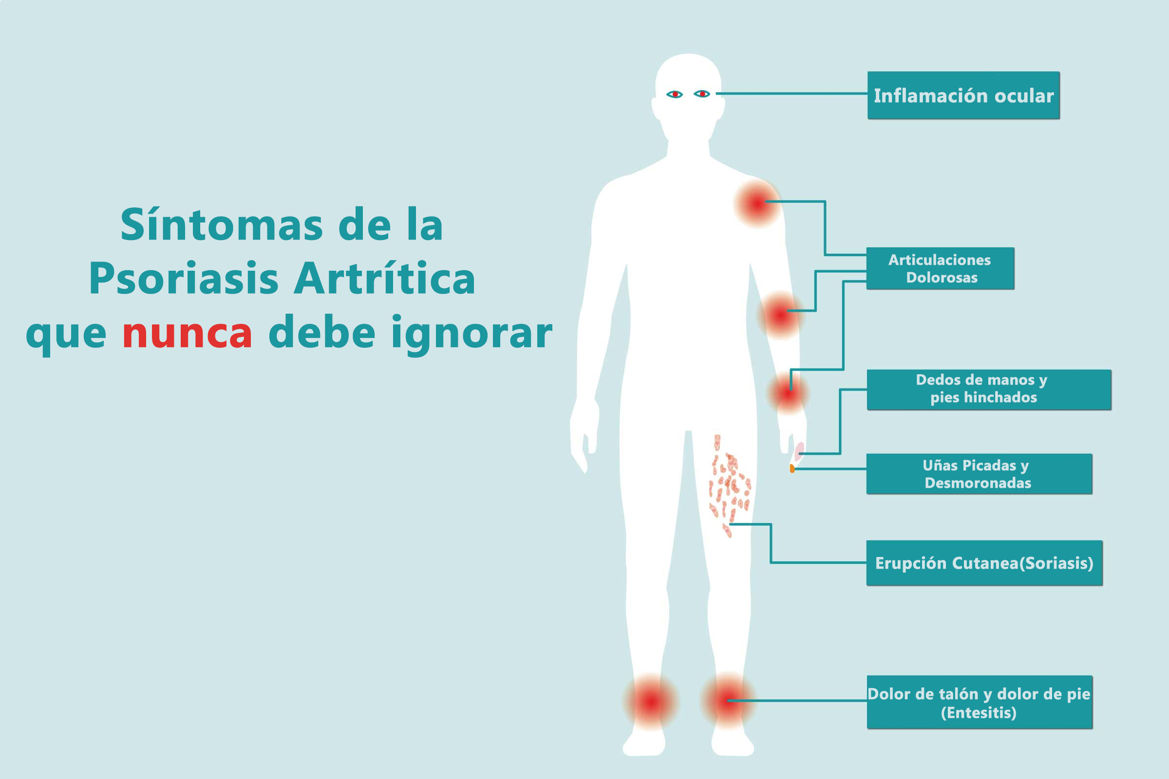 Síntomas de la Psoriasis Artrítica